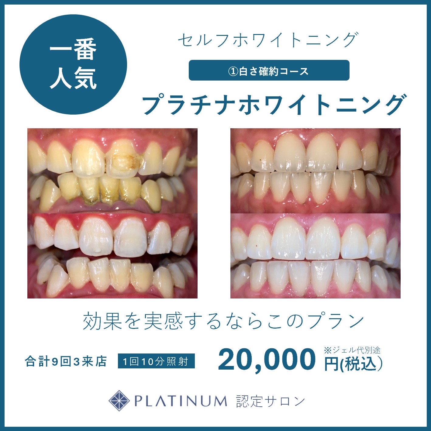プラチナホワイトニングのイメージ